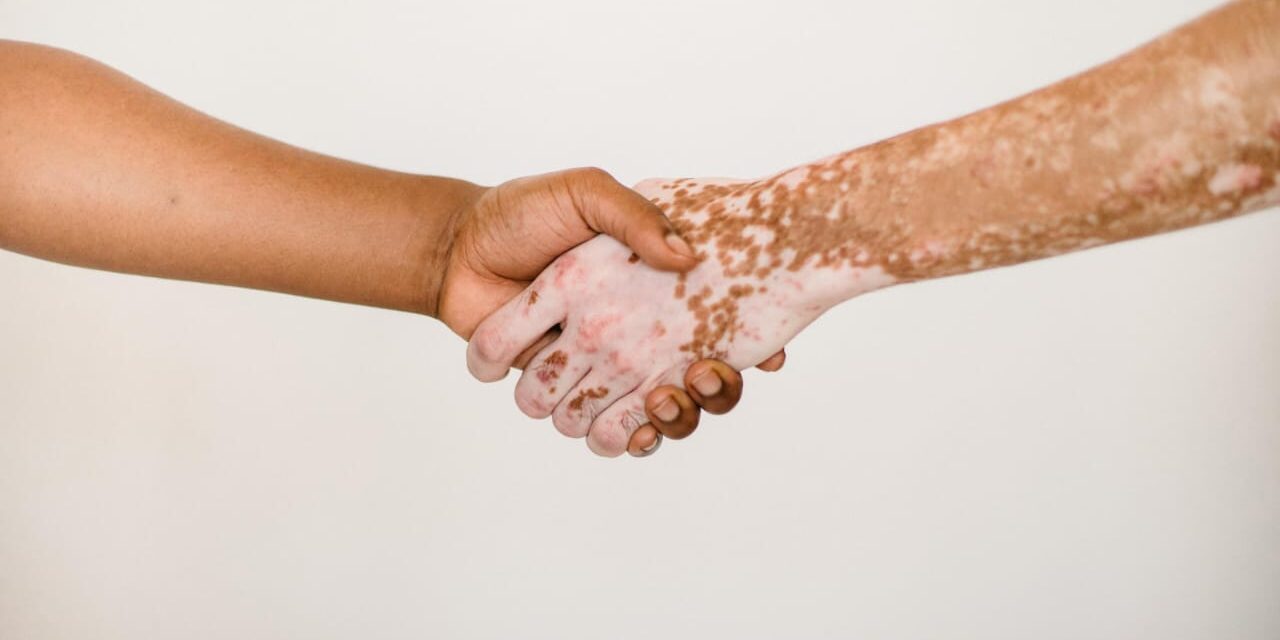 UNA ENFERMEDAD CUTÁNEA, PERO NO CONTAGIOSA